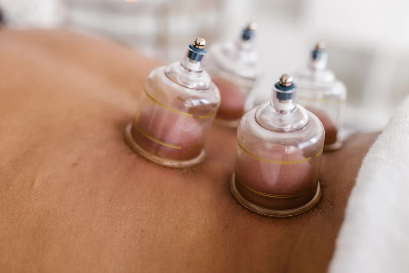 Cupping therapy cups applied to a patient's back during a treatment session